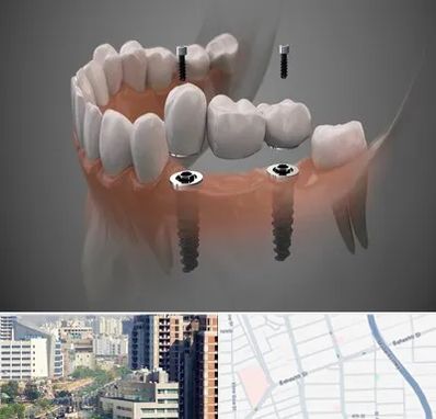 ایمپلنت دیجیتال در خیابان بهشتی