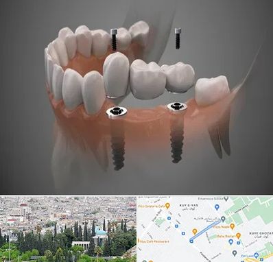 ایمپلنت دیجیتال در محلاتی شیراز