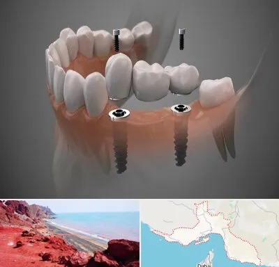 ایمپلنت دیجیتال در هرمزگان