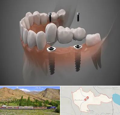 ایمپلنت دیجیتال در خاش