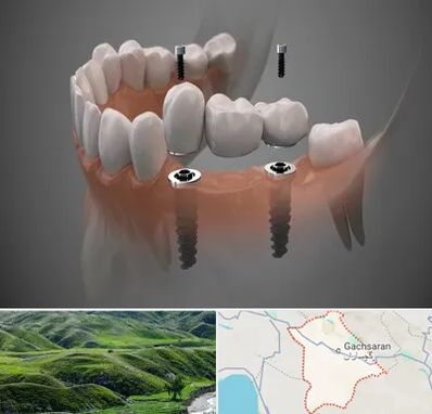 ایمپلنت دیجیتال در گچساران
