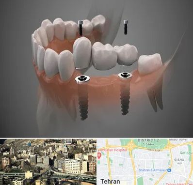 ایمپلنت دیجیتال در مرزداران 