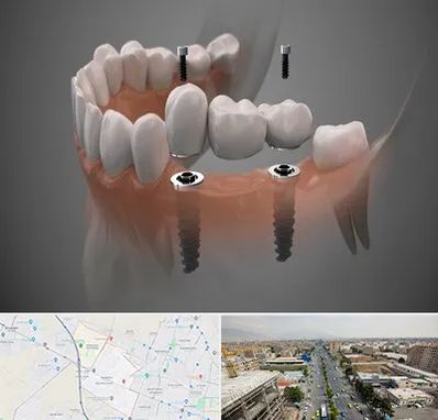 ایمپلنت دیجیتال در حصارک کرج