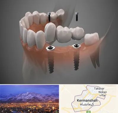 ایمپلنت دیجیتال در کرمانشاه