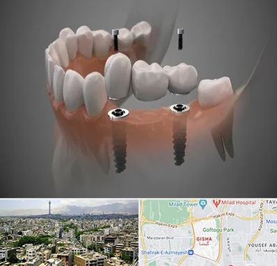 ایمپلنت دیجیتال در گیشا 