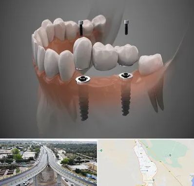 ایمپلنت دیجیتال در اندیمشک