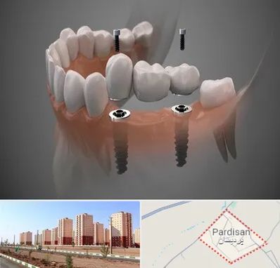 ایمپلنت دیجیتال در پردیسان قم