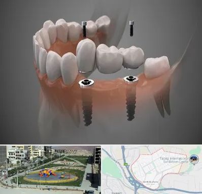 ایمپلنت دیجیتال در مرزداران تبریز