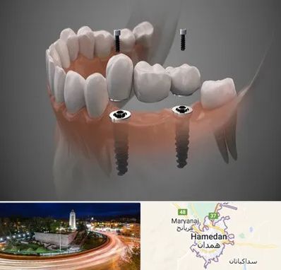 ایمپلنت دیجیتال در همدان