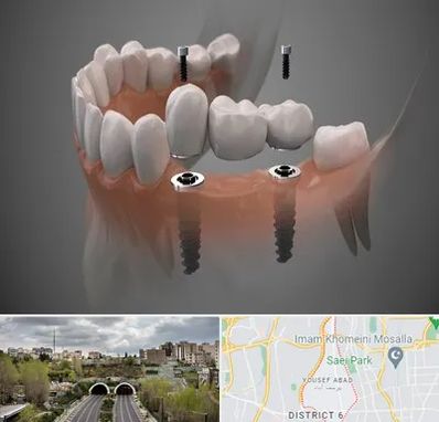 ایمپلنت دیجیتال در یوسف آباد 