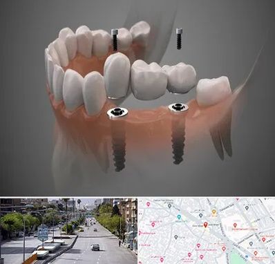 ایمپلنت دیجیتال در خیابان زند شیراز