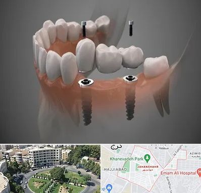 ایمپلنت دیجیتال در جهانشهر کرج 