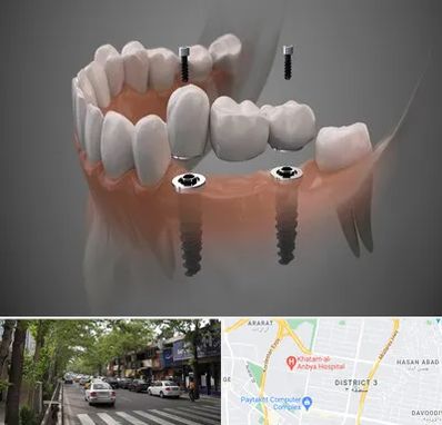 ایمپلنت دیجیتال در ظفر 