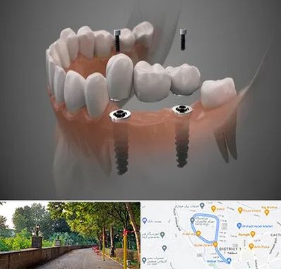 ایمپلنت دیجیتال در فلکه گاز رشت