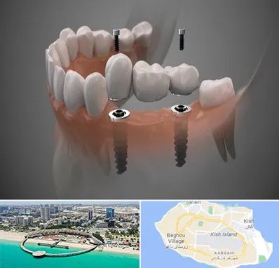 ایمپلنت دیجیتال در کیش