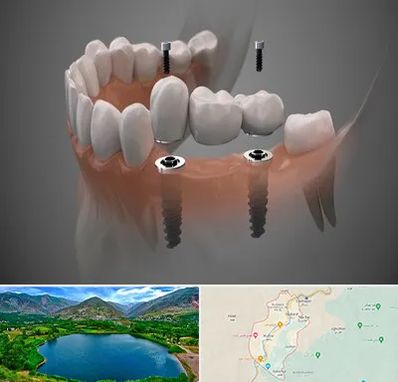 ایمپلنت دیجیتال در رودبار