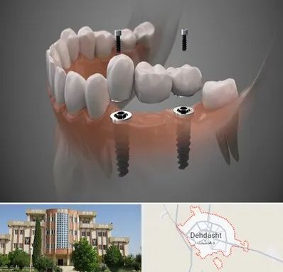ایمپلنت دیجیتال در دهدشت