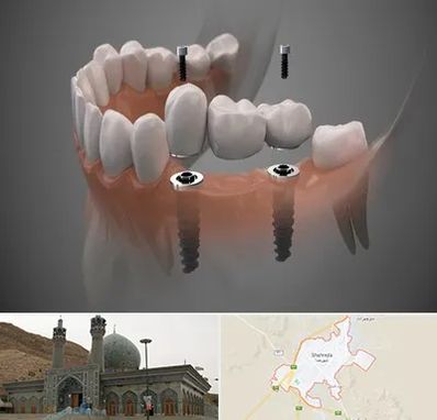 ایمپلنت دیجیتال در شهرضا