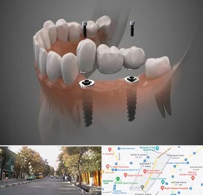 ایمپلنت دیجیتال در شریعتی 