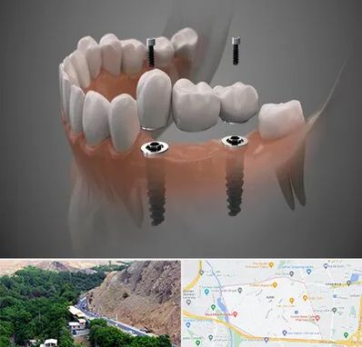 ایمپلنت دیجیتال در کن