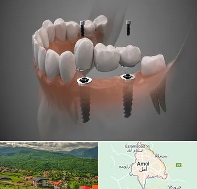 ایمپلنت دیجیتال در آمل