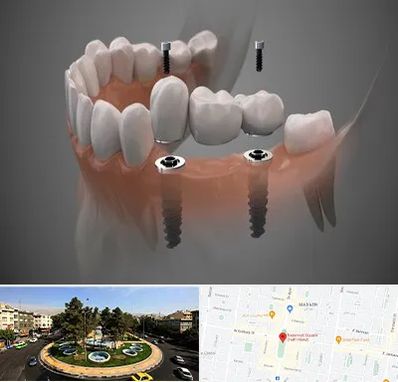 ایمپلنت دیجیتال در هفت حوض