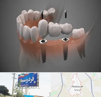 ایمپلنت دیجیتال در فردوسیه شهریار