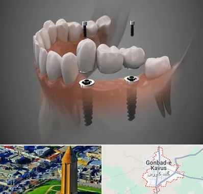 ایمپلنت دیجیتال در گنبد کاووس