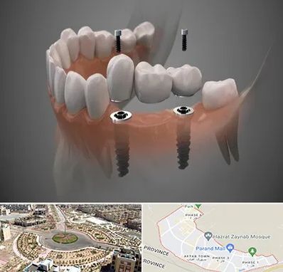 ایمپلنت دیجیتال در پرند