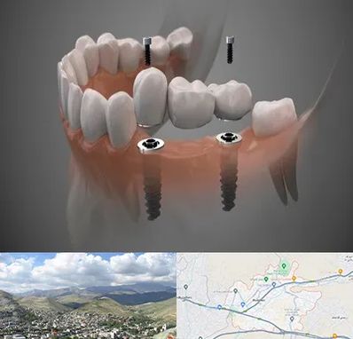 ایمپلنت دیجیتال در رودهن