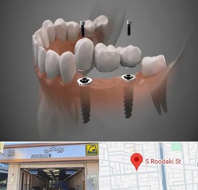 ایمپلنت دیجیتال در رودکی