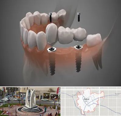 ایمپلنت دیجیتال در زابل