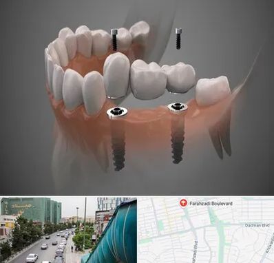 ایمپلنت دیجیتال در بلوار فرحزادی