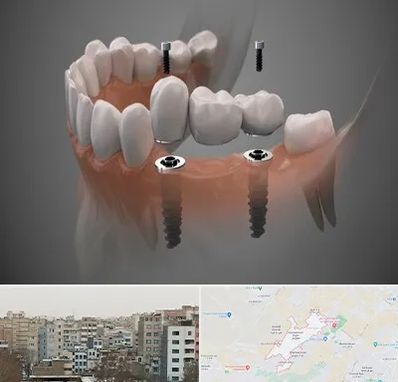 ایمپلنت دیجیتال در محمد شهر کرج