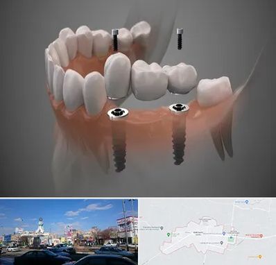 ایمپلنت دیجیتال در ماهدشت کرج