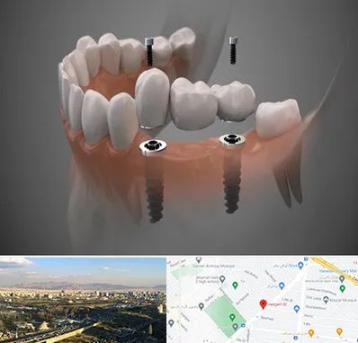 ایمپلنت دیجیتال در هنگام