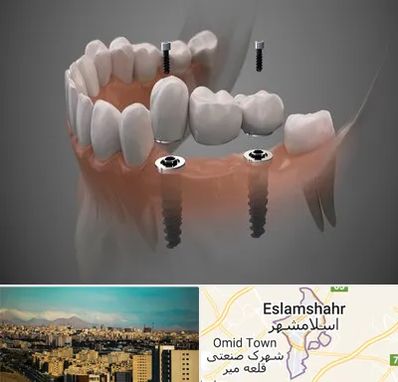 ایمپلنت دیجیتال در اسلامشهر