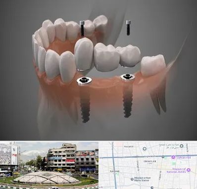 ایمپلنت دیجیتال در مرکز تهران