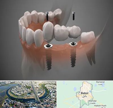 ایمپلنت دیجیتال در بابل