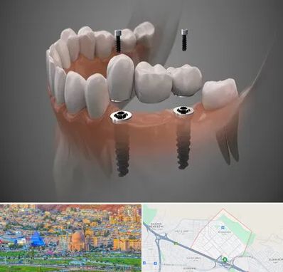 ایمپلنت دیجیتال در رشدیه تبریز