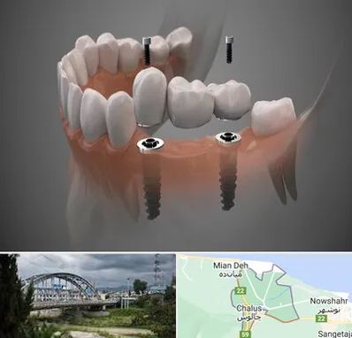 ایمپلنت دیجیتال در چالوس