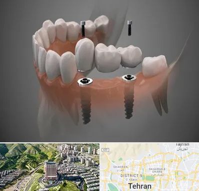 ایمپلنت دیجیتال در شمال تهران 