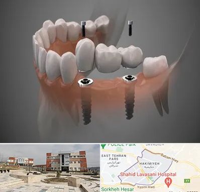 ایمپلنت دیجیتال در حکیمیه 