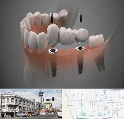 ایمپلنت دیجیتال در 17شهریور