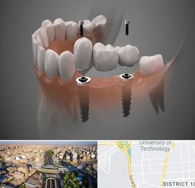 ایمپلنت دیجیتال در استاد معین 