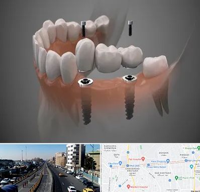 ایمپلنت دیجیتال در پیروزی 