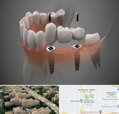 ایمپلنت دیجیتال در اکباتان 