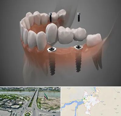 ایمپلنت دیجیتال در میاندوآب