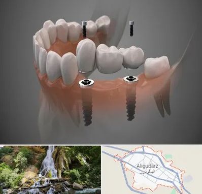 ایمپلنت دیجیتال در الیگودرز