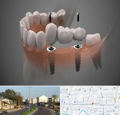 ایمپلنت دیجیتال در ضیابری رشت